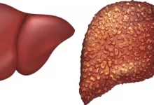 أنواع التهاب الكبد من الأعراض إلى العلاج