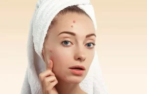 طرق طبيعية للوقاية من حب الشباب