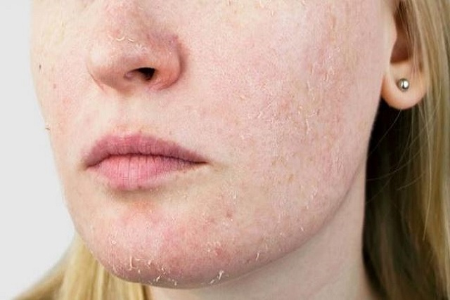 أنواع البشرة وكيفية معرفتها