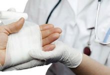 طرق فعالة في علاج الحروق في المنزل