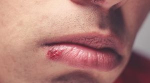 4 أمراض تنتقل بالتقبيل