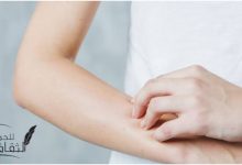 علاج الهرش الشديد والوقاية منه