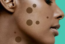 9 طرق للتخلص من بقع الجلد البنية ومعرفة سبب ظهورها