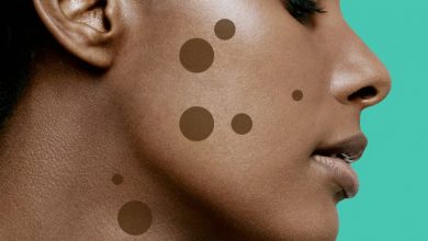 9 طرق للتخلص من بقع الجلد البنية ومعرفة سبب ظهورها