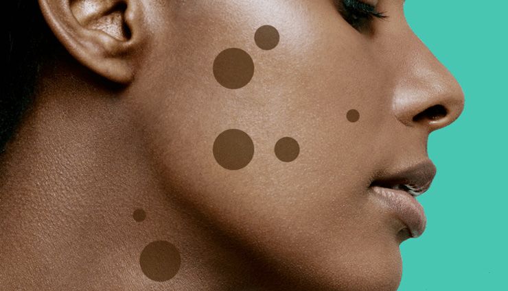 9 طرق للتخلص من بقع الجلد البنية ومعرفة سبب ظهورها